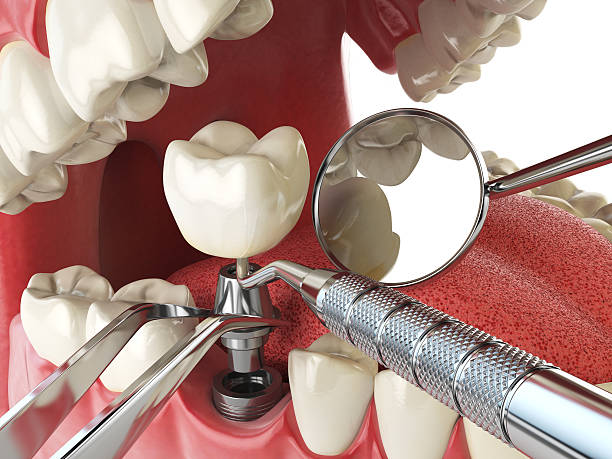Best Emergency Gum Treatment in Pinecrest, FL
